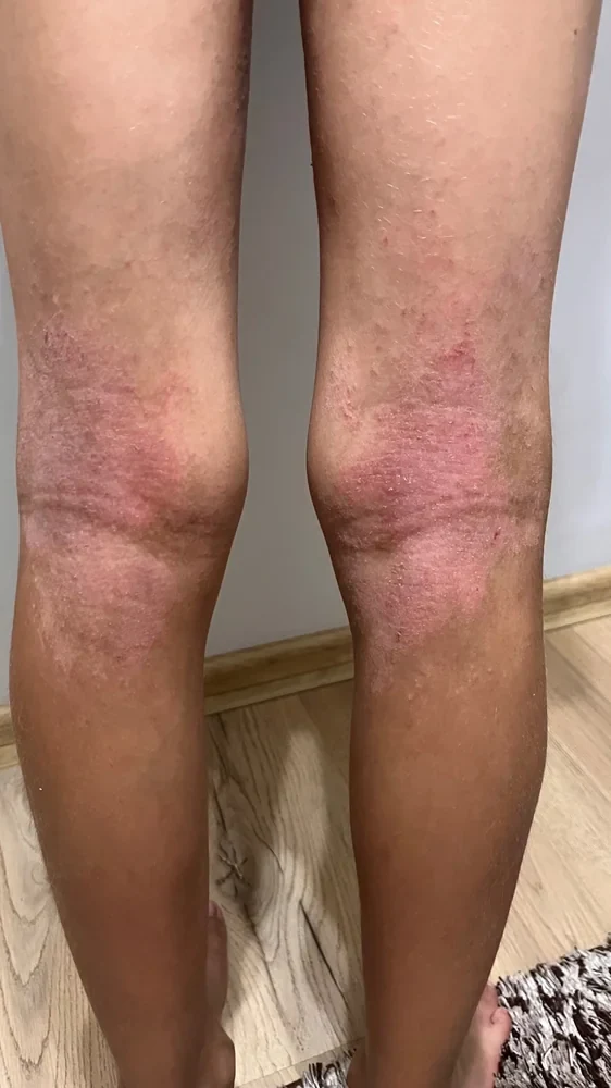 ozonko dermatitis