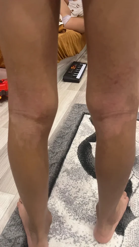 ozonko dermatitis healed